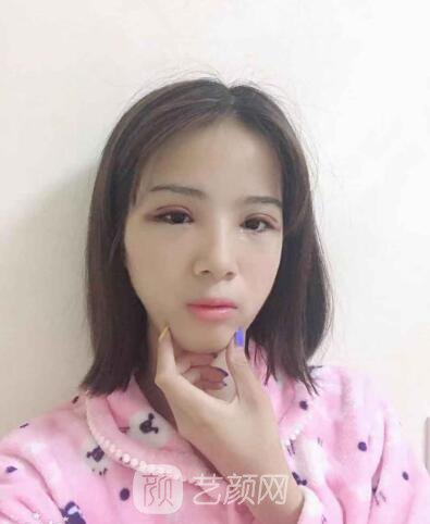 眼部手術(shù)真人案例