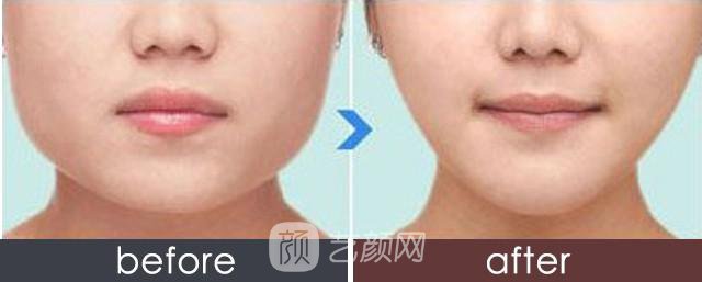 蘇州注射瘦臉注射瘦臉多少錢?