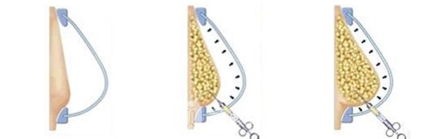 注射隆胸失敗修復多少錢?