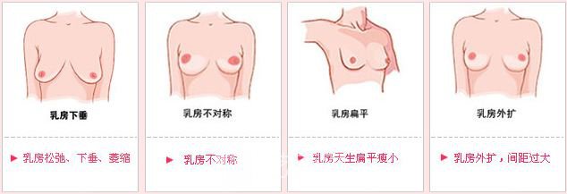 內(nèi)窺鏡假體隆胸多少錢?