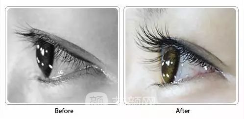 睫毛移植多少錢(qián)?