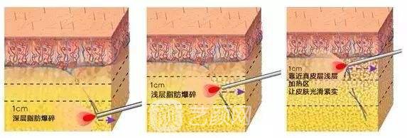 光纖溶脂多少錢?