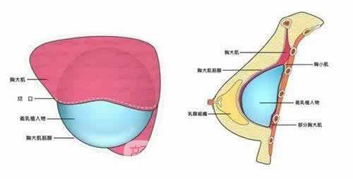 杭州韓式隆胸整形費(fèi)用?