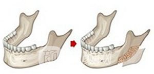 磨下頜角有風(fēng)險(xiǎn)嗎?