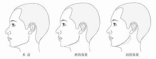磨下頜角有風(fēng)險(xiǎn)嗎?