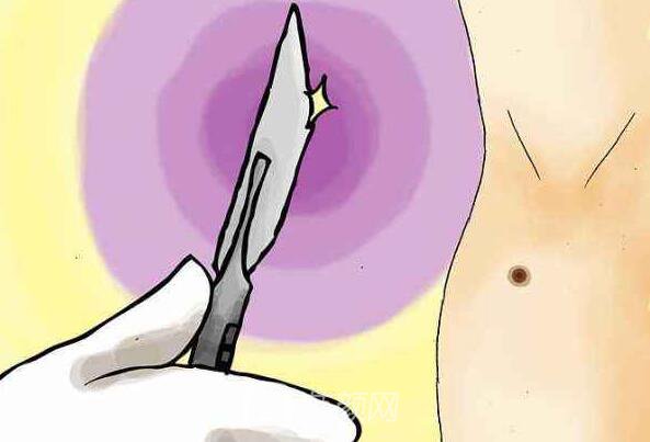 【祛痣平瘊去哪里好？】