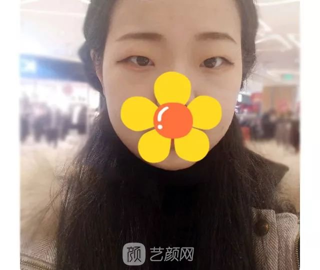 脂美人雙眼皮手術(shù)大公開(kāi)！我終于整容了！