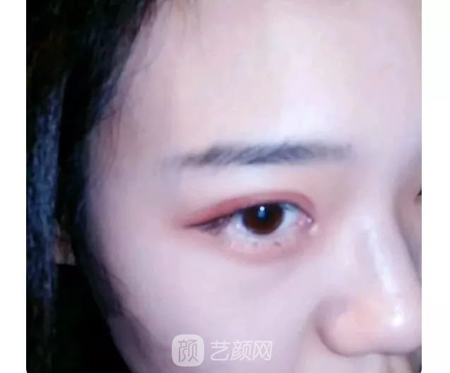 脂美人雙眼皮手術(shù)大公開(kāi)！我終于整容了！