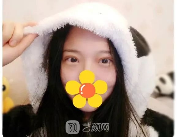 脂美人雙眼皮手術(shù)大公開(kāi)！我終于整容了！