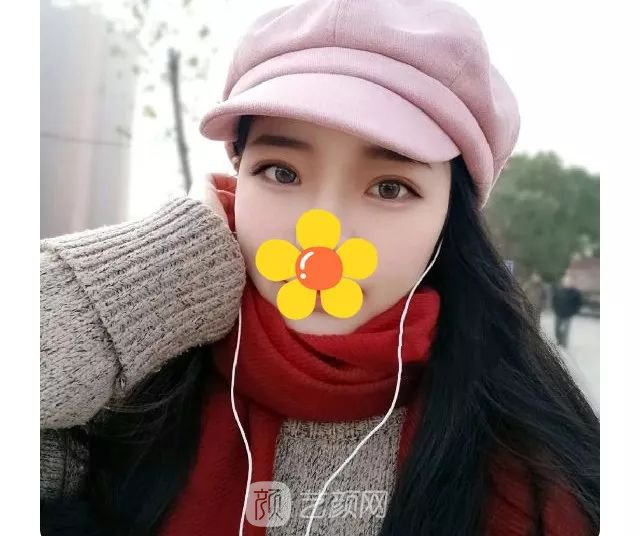 脂美人雙眼皮手術(shù)大公開(kāi)！我終于整容了！