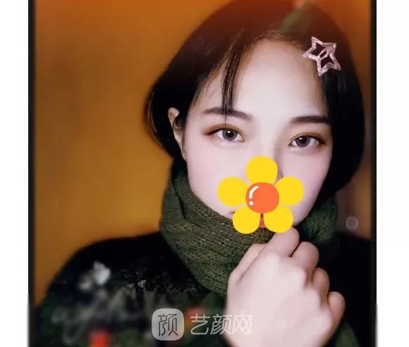 脂美人雙眼皮手術(shù)大公開(kāi)！我終于整容了！