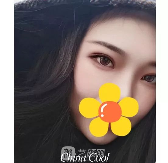 脂美人雙眼皮手術(shù)大公開(kāi)！我終于整容了！