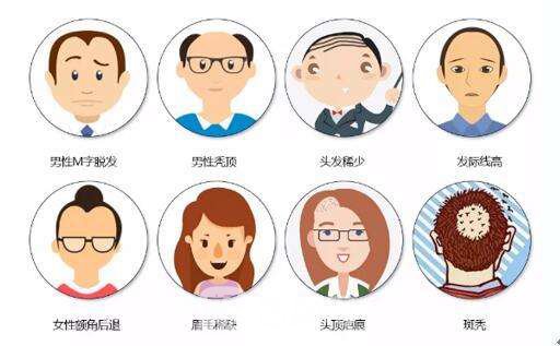 頭發(fā)移植費用多少錢呢