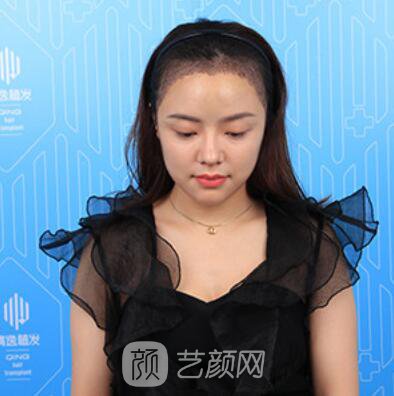 做好發(fā)際線后堪比微調(diào)的真實(shí)經(jīng)歷分享