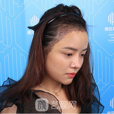 做好發(fā)際線后堪比微調(diào)的真實(shí)經(jīng)歷分享