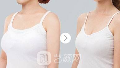 乳房縮小需要多少錢?