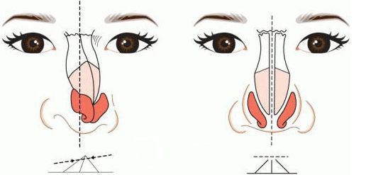 【假體隆鼻能維持多久？術(shù)后10年需每年檢測(cè)一次價(jià)格幾千到幾萬(wàn)不等~】