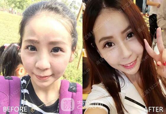 只需要5分鐘，我的鼻子變高了！——南京藝星玻尿酸隆鼻~