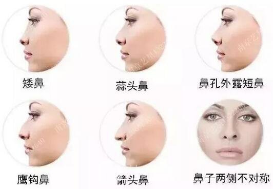 只需要5分鐘，我的鼻子變高了！——南京藝星玻尿酸隆鼻~