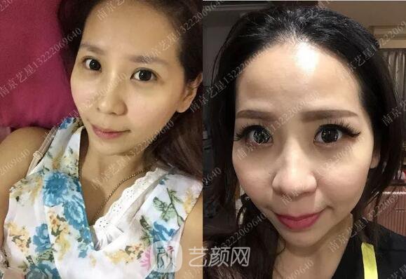 只需要5分鐘，我的鼻子變高了！——南京藝星玻尿酸隆鼻~