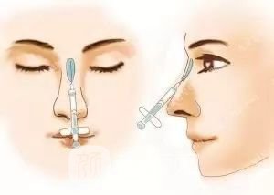 只需要5分鐘，我的鼻子變高了！——南京藝星玻尿酸隆鼻~