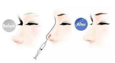 只需要5分鐘，我的鼻子變高了！——南京藝星玻尿酸隆鼻~