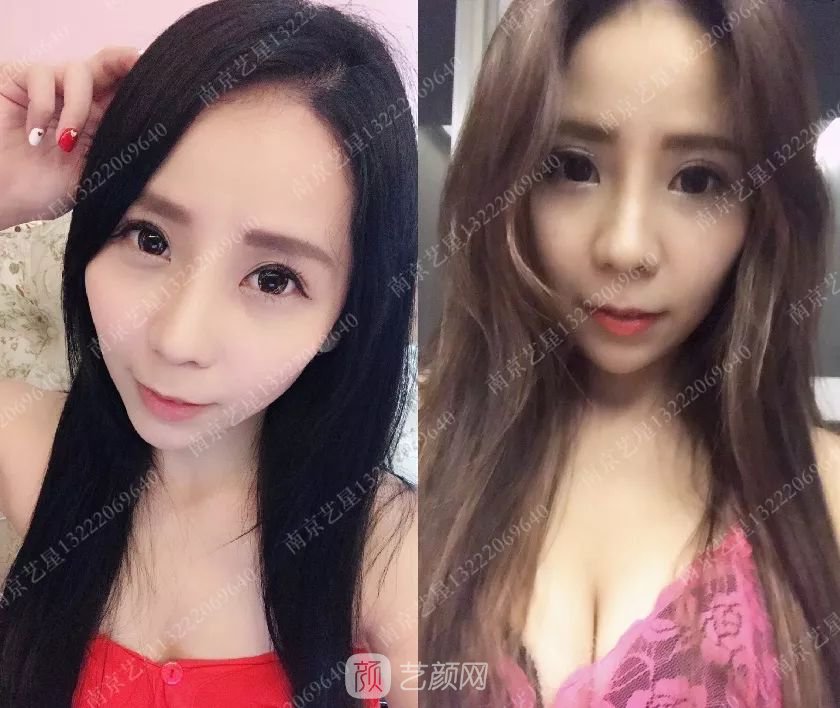 只需要5分鐘，我的鼻子變高了！——南京藝星玻尿酸隆鼻~