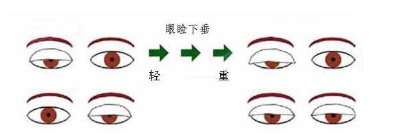 公立醫(yī)院上瞼下垂矯正什么價位?