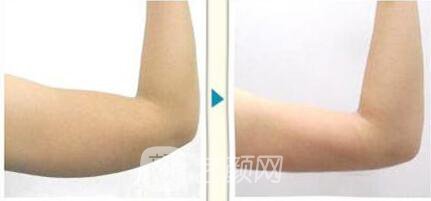 吸脂手臂手術(shù)多少錢?