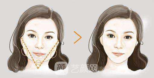 上海磨下頜角多少錢?