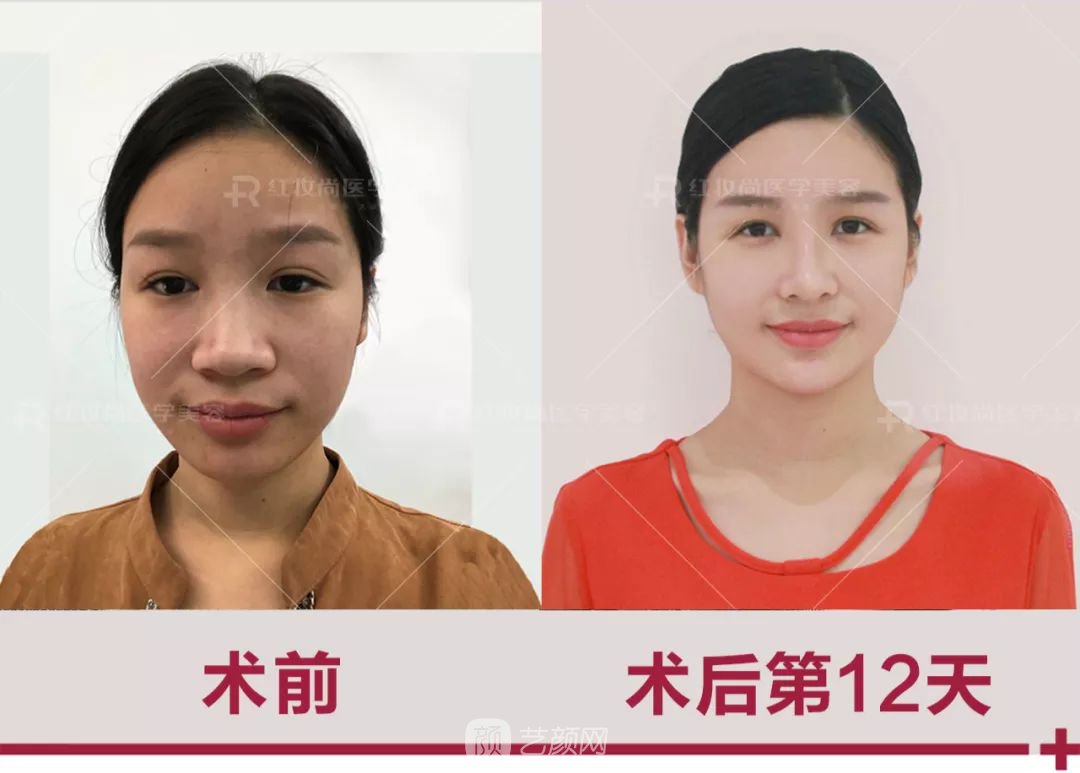 【蛻變?nèi)沼洝拷^美側(cè)顏的秘密——分享我的美鼻之旅~