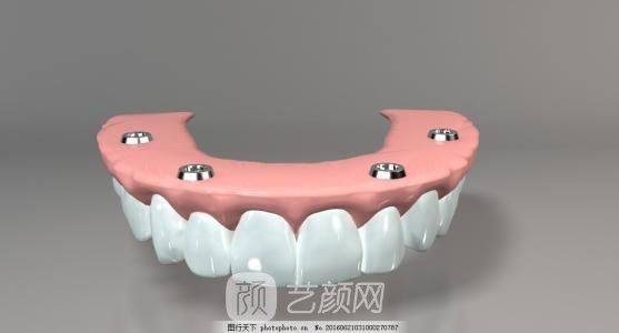 全口種植牙的價格?