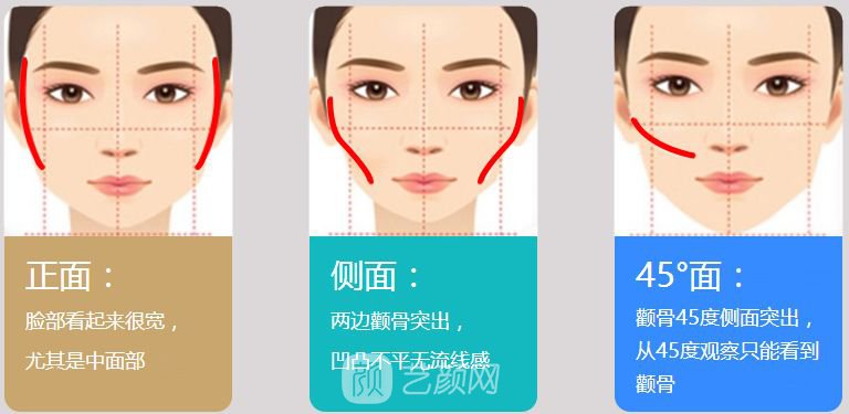 3d顴骨內(nèi)推多少錢?