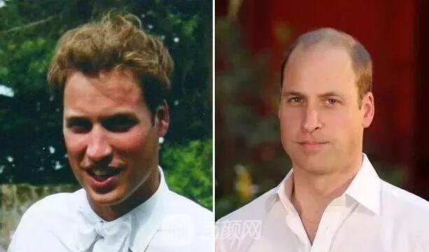 徐崢回應(yīng)脫發(fā)、英國小刺猬因壓力大脫毛！不得不說“禿”真是不分界的...