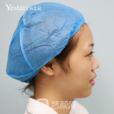 上海藝星切開雙眼皮案例，論雙眼皮的重要性