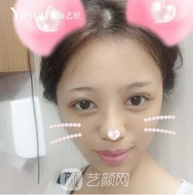 上海藝星切開雙眼皮案例，論雙眼皮的重要性