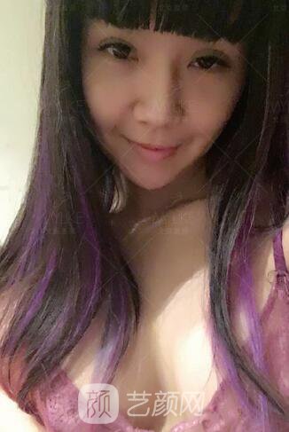 產(chǎn)后媽媽假體隆胸真實案例恢復(fù)過程