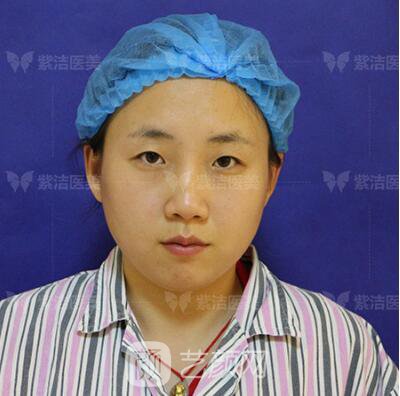 北京紫潔醫(yī)療美容全切雙眼皮案例過(guò)程恢復(fù)