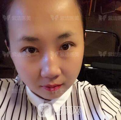 北京紫潔醫(yī)療美容全切雙眼皮案例過(guò)程恢復(fù)