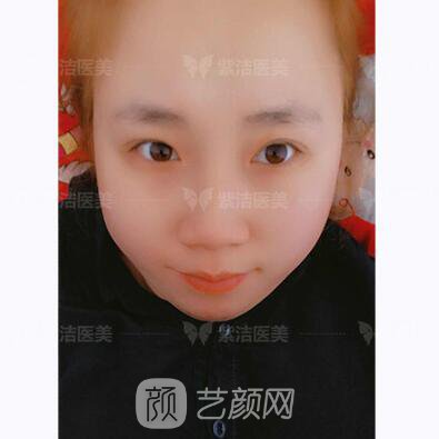 北京紫潔醫(yī)療美容全切雙眼皮案例過(guò)程恢復(fù)
