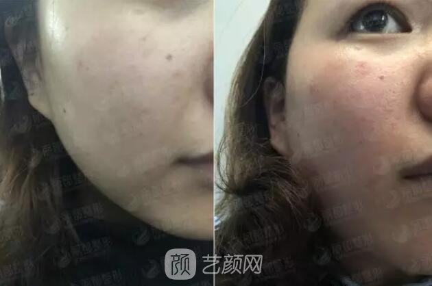 祛紅血絲的N種方式，讓你告別尷尬“紅臉蛋兒”！