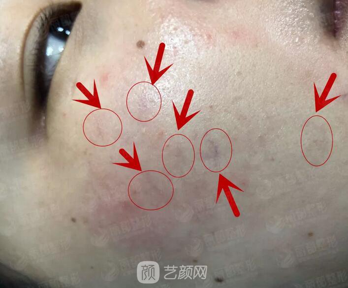 祛紅血絲的N種方式，讓你告別尷尬“紅臉蛋兒”！