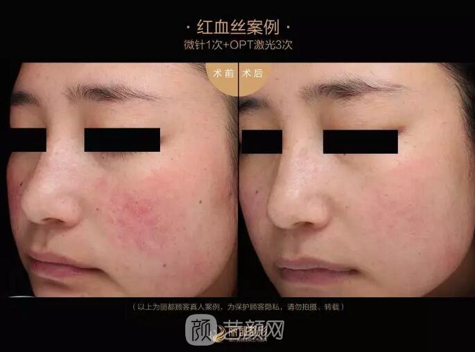 祛紅血絲的N種方式，讓你告別尷尬“紅臉蛋兒”！