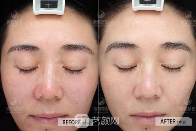 祛紅血絲的N種方式，讓你告別尷尬“紅臉蛋兒”！