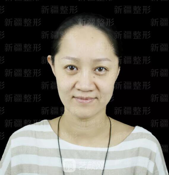 埋線提升提拉只是下垂的皮膚？不，更是我逝去的年華~