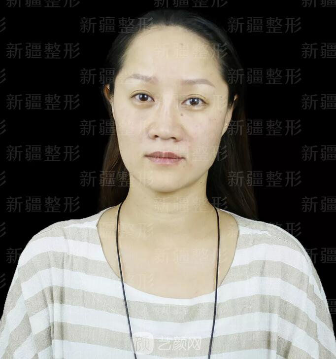 埋線提升提拉只是下垂的皮膚？不，更是我逝去的年華~