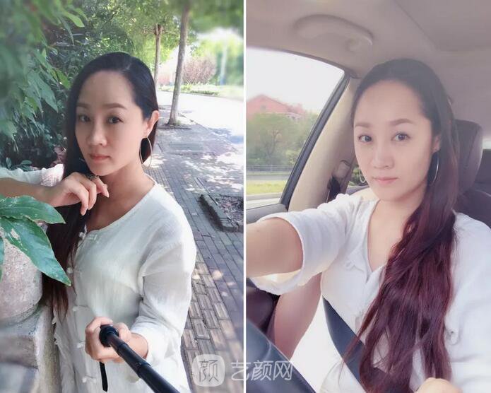 埋線提升提拉只是下垂的皮膚？不，更是我逝去的年華~