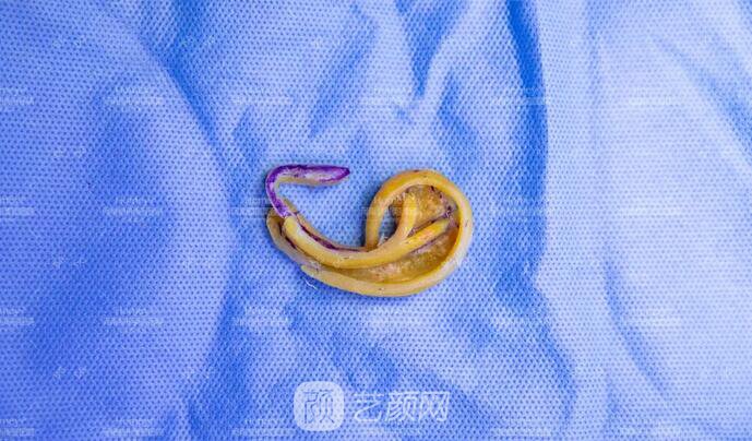 【取肋軟骨會影響孩子胸廓發(fā)育嗎？】