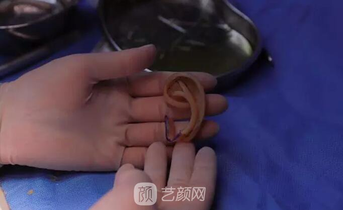 【再造的耳朵軟硬度摸起來和正常耳朵一樣嗎？】