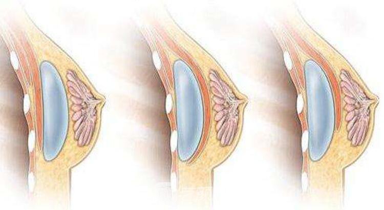 【選擇隆胸手術(shù)都有哪些原因】